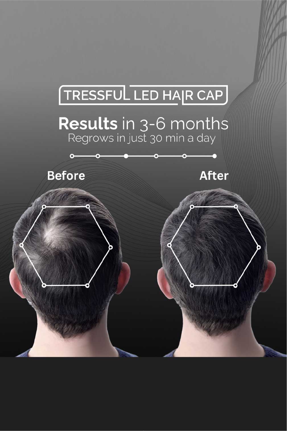 Tressful LED hair cap before and after results for hair regrowth within 3-6 months.