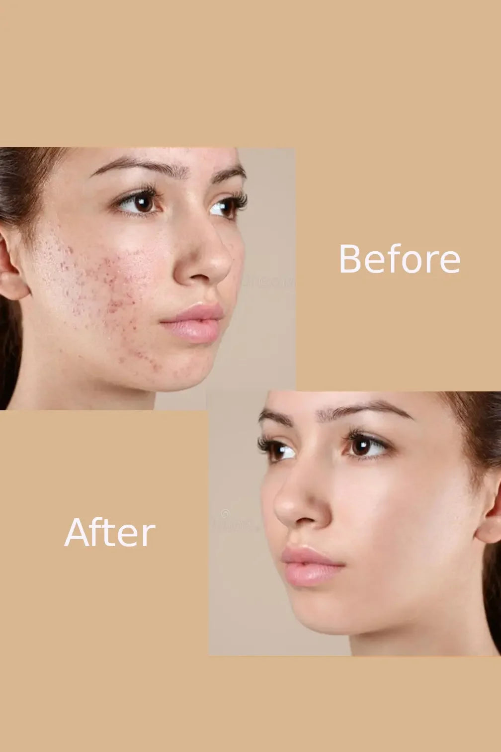Before and after photos of a woman's face showing reduced acne and clearer skin