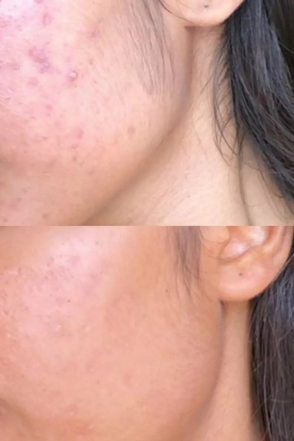 Before and after close-up of cheek showing improved acne and smoother skin